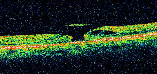 Stage 2 20/100 Idiopathic Macular Hole
62-year-old woman has a macular hole in the left eye.  Her vision is worse than when she was here 1 month ago with a 100 micron hole

VISUAL ACUITY:  OS 20/100.
