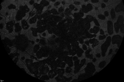 Macular Laser Scars - Central Retinal Vein Occlusion - Patients Only Eye - Fundus Autofluorescence
80-year-old woman left eye had a vascular occlusion, probably about five years ago, subsequent to that she had macular laser. She said since then the vision has been poor. OS 20/160.
