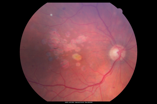 Diabetic Retinopathy - Foveal Laser Scar Right Eye
74-year-old woman has diabetic retinopathy in both eyes.  She has had focal laser in her right eye done elsewhere in the mid 90â€™s and unfortunately the laser was fairly close to the center and as time progressed she developed foveal atrophy around the scars.  She has noticed her vision declining since she was here last a year ago.  She does take Travatan in both eyes at night for glaucoma. 

VISUAL ACUITY:  OD 20/200,  OS 20/40. 
