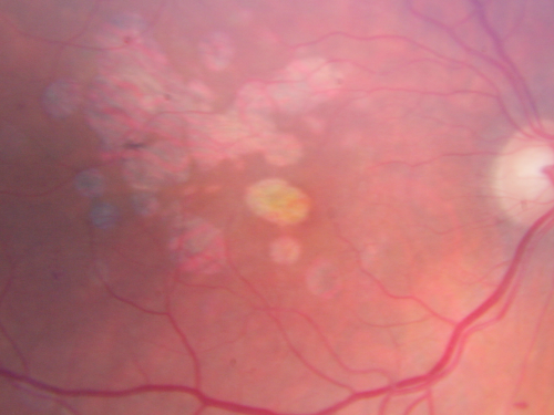 Diabetic Retinopathy - Foveal Laser Scar Right Eye
74-year-old woman has diabetic retinopathy in both eyes.  She has had focal laser in her right eye done elsewhere in the mid 90â€™s and unfortunately the laser was fairly close to the center and as time progressed she developed foveal atrophy around the scars.  She has noticed her vision declining since she was here last a year ago.  She does take Travatan in both eyes at night for glaucoma. 

VISUAL ACUITY:  OD 20/200,  OS 20/40. 
