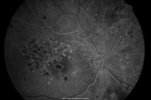Diabetic Retinopathy - Foveal Laser Scar Right Eye
74-year-old woman has diabetic retinopathy in both eyes.  She has had focal laser in her right eye done elsewhere in the mid 90â€™s and unfortunately the laser was fairly close to the center and as time progressed she developed foveal atrophy around the scars.  She has noticed her vision declining since she was here last a year ago.  She does take Travatan in both eyes at night for glaucoma. 

VISUAL ACUITY:  OD 20/200,  OS 20/40. 

