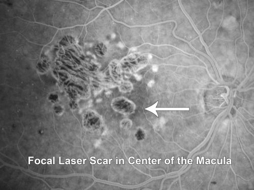 Diabetic Retinopathy - Foveal Laser Scar Right Eye
74-year-old woman has diabetic retinopathy in both eyes.  She has had focal laser in her right eye done elsewhere in the mid 90â€™s and unfortunately the laser was fairly close to the center and as time progressed she developed foveal atrophy around the scars.  She has noticed her vision declining since she was here last a year ago.  She does take Travatan in both eyes at night for glaucoma. 

VISUAL ACUITY:  OD 20/200,  OS 20/40. 
