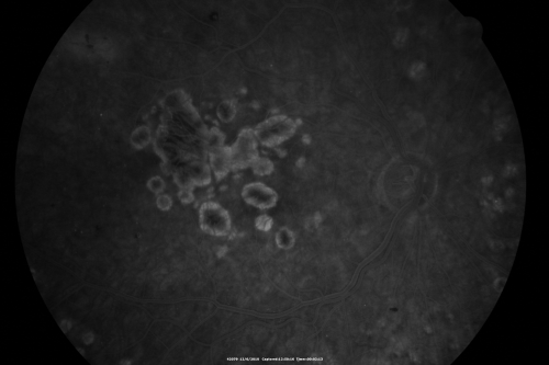 Diabetic Retinopathy - Foveal Laser Scar Right Eye
74-year-old woman has diabetic retinopathy in both eyes.  She has had focal laser in her right eye done elsewhere in the mid 90â€™s and unfortunately the laser was fairly close to the center and as time progressed she developed foveal atrophy around the scars.  She has noticed her vision declining since she was here last a year ago.  She does take Travatan in both eyes at night for glaucoma. 

VISUAL ACUITY:  OD 20/200,  OS 20/40. 
