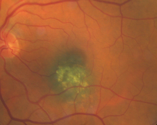 Macular Choroidal Nevus
78-year-old woman has choroidal nevus in the macula of the left eye.  You asked her to come in here for an evaluation and nevus was noted in the past about 7 years ago.  She has not noticed any change in vision in that eye.

VISUAL ACUITY:  OU 20/30. 
Schlüsselwörter: nevus;macula;drusen