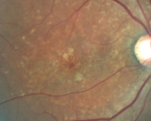 Stargardt's Juvenille Macular Dystrophy - Fundus Flavimaculatus - Famlial
55-year-old woman was seen in the office on 11/18/08.  She has a half sister with Stargardtâ€™s disease and seven other siblings who are fine.  20/120 OD, 20/160 OS.
