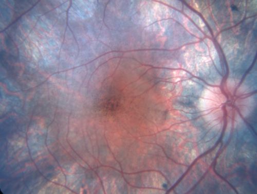 Gyrate Atrophy - 15 year old male - 20/25 vision both eyes - Positive Family History
15 year old male was diagnosed with â€œretinitis pigmentosaâ€ at age seven.  The patient reports that his night vision is poor.  He reports he does not notice a visual field change.  He reports that his maternal grandfather has lost vision and a cousin has lost vision as well.  He reports he has an uncle with some visual changes.
The most significantly affected relative is a 26-year-old legally blind cousin.
 20/25+ OD, 20/25 OS. 
