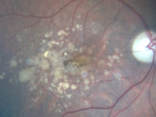 Drusen Maculopathy 85 year old Male
85-year-old man has age-related macular degeneration in both eyes with drusen maculopathy. OD is 20/40, OS is 20/400
