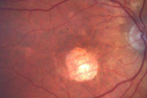 Central Areolar Choroidal Sclerosis
Elderly man with poor central vision starting in his 50's
