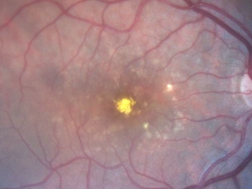 Adult Vitelliform Macular Dystrophy - Pattern Dystrophy
69-year-old woman sees a dark spot centrally.  When she looks at things she loses letters and numbers and is having more and more difficulty balancing her checkbook.  OD is 20/80, OS is 20/40
