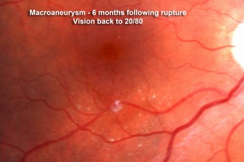 Retinal Arterial Macroaneurysm - Ruptured and self Sealed - Vision Back to 20/80 after 6 Months
81-year-old woman vision improving 6 months following rupture of retinal arterial macroaneurysm. Vision OD is 20/80
