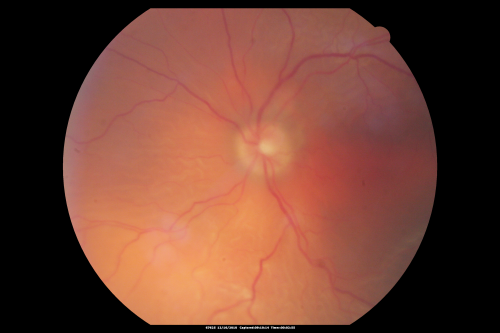 Pre-operative photograph - macula off, 3/200 retinal detachment
61-year-old man decreased vision left eye for 2 weeks.

VISUAL ACUITY:  OD 20/25,  OS 3/200
