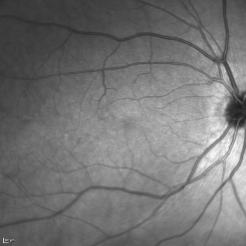 Dehydration Injury to Retina after Macula-On Retinal Detachment Repair - Also Subretinal Perfluoron
18 month ago he had a scleral buckle, vitrectomy, laser and gas for macula on retinal detachment. Since he notices blind spots in the center of the left eye/ He also notices a dense, inferior visual field defect. OD 20/20,  OS 20/50
