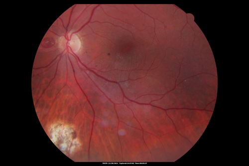 Dehydration Injury to Retina after Macula-On Retinal Detachment Repair - Also Subretinal Perfluoron
18 month ago he had a scleral buckle, vitrectomy, laser and gas for macula on retinal detachment. Since he notices blind spots in the center of the left eye/ He also notices a dense, inferior visual field defect. OD 20/20,  OS 20/50
