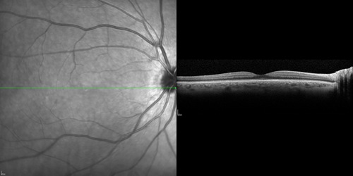 Dehydration Injury to Retina after Macula-On Retinal Detachment Repair - Also Subretinal Perfluoron
18 month ago he had a scleral buckle, vitrectomy, laser and gas for macula on retinal detachment. Since he notices blind spots in the center of the left eye/ He also notices a dense, inferior visual field defect. OD 20/20,  OS 20/50
