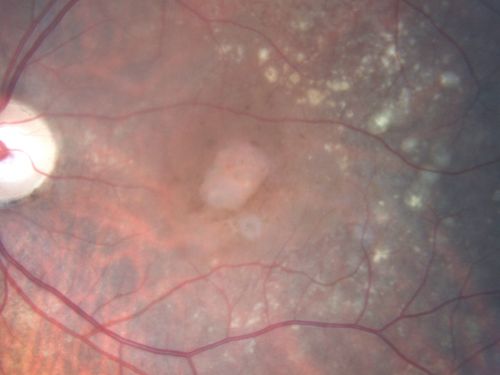 Drusen Maculopathy 85 year old Male
85-year-old man has age-related macular degeneration in both eyes with drusen maculopathy. OD is 20/40, OS is 20/400
