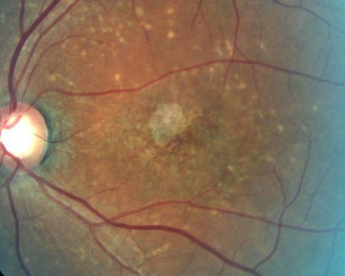 Stargardt's Juvenille Macular Dystrophy - Fundus Flavimaculatus - Famlial
55-year-old woman was seen in the office on 11/18/08.  She has a half sister with Stargardtâ€™s disease and seven other siblings who are fine.  20/120 OD, 20/160 OS.
