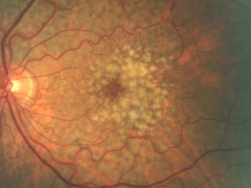 Reticular Macular Disease - Reticular Pseudodrusen and Soft Macular Drusen - 57 Year Old Woman
57-year-old woman was seen in the office on 2/22/2011.  She has macular drusen in both eyes.  I saw her back in 2006.  Since then she does notice slight increased distortion.  OD is 20/25, OS is 20/25
