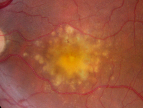 Drusen Maculopathy - Confluent Subfoveal Soft Hydrophobic Drusen - Yellow Drusen in Center of the Macula

