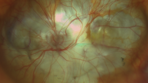 Staphyloma and Atrophy with Vitreoretinal traction
Only eye of patient with Albinism and decreasing vision now 5/200 in this 72 year old man.  There is myopic tractional maculopathy.  The patient also has albinism by history.
