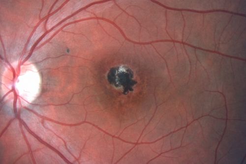 Toxoplasmosis Macular Scar (acquired not congenital) 31 Year Old Man- Recent Vision Change - Creeping Scar
31-year-old man had an episode of toxoplasmosis in the left eye, where unfortunately it adversely affected his central vision that was back in 2004 (7 years ago)
He did notice recently a change in his visual function.  He plays softball, he was getting hit by the ball and having trouble seeing and he said that is how he noticed the toxoplasmosis when it first occurred and he was concerned it might have recurred. 
OD 20/16,  OS 20/80. 
