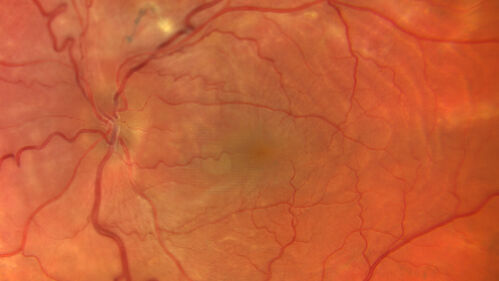 Nanophthalmous
Family history of poor eyes and bad vision since age 4
VA OD: Dsc20/80 
VA OS: Dsc20/125-2
