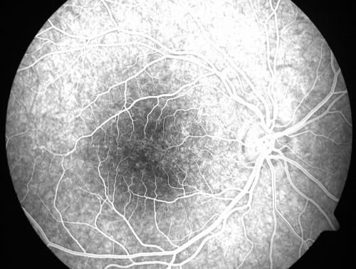 Pigmented Maculae - Mother and Daughter - Normal Visual Acuity
12-year-old  had a dilated macular exam and the macula look abnormal.  Interestingly, her mother, who is with her at this visit, was told about a year ago that her maculae are abnormal too.  Her motherâ€™s vision is fine.  In the family tree, there are no known retinal dystrophies.  They are both healthy.

VISUAL ACUITY:  Her vision is 20/20 in both eyes.
