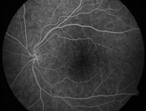 Pigmented Maculae - Mother and Daughter - Normal Visual Acuity
12-year-old  had a dilated macular exam and the macula look abnormal.  Interestingly, her mother, who is with her at this visit, was told about a year ago that her maculae are abnormal too.  Her motherâ€™s vision is fine.  In the family tree, there are no known retinal dystrophies.  They are both healthy.

VISUAL ACUITY:  Her vision is 20/20 in both eyes.
