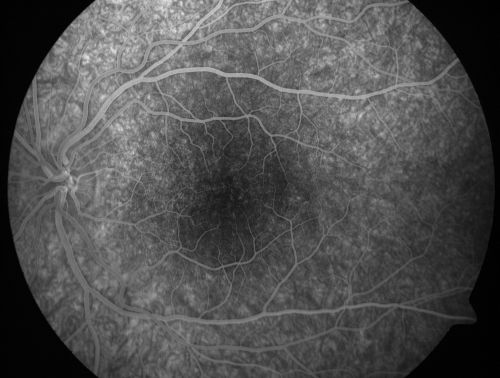 Pigmented Maculae - Mother and Daughter - Normal Visual Acuity
12-year-old  had a dilated macular exam and the macula look abnormal.  Interestingly, her mother, who is with her at this visit, was told about a year ago that her maculae are abnormal too.  Her motherâ€™s vision is fine.  In the family tree, there are no known retinal dystrophies.  They are both healthy.

VISUAL ACUITY:  Her vision is 20/20 in both eyes.

