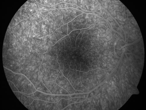 Pigmented Maculae - Mother and Daughter - Normal Visual Acuity
12-year-old  had a dilated macular exam and the macula look abnormal.  Interestingly, her mother, who is with her at this visit, was told about a year ago that her maculae are abnormal too.  Her motherâ€™s vision is fine.  In the family tree, there are no known retinal dystrophies.  They are both healthy.

VISUAL ACUITY:  Her vision is 20/20 in both eyes.
