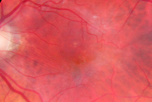 Macular Pucker 20/40 vision and recent cataract surgery
 73-year-old man distortion and vision loss since ECCE 6 months ago OS.  Patient taking anti-inflammatory drops. VISUAL ACUITY:  OD 20/30,  OS 20/40.
