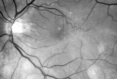 Macular Pucker 20/40 vision and recent cataract surgery
 73-year-old man distortion and vision loss since ECCE 6 months ago OS.  Patient taking anti-inflammatory drops. VISUAL ACUITY:  OD 20/30,  OS 20/40.
