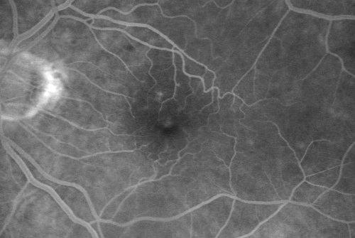 Macular Pucker 20/40 vision and recent cataract surgery
 73-year-old man distortion and vision loss since ECCE 6 months ago OS.  Patient taking anti-inflammatory drops. VISUAL ACUITY:  OD 20/30,  OS 20/40.
