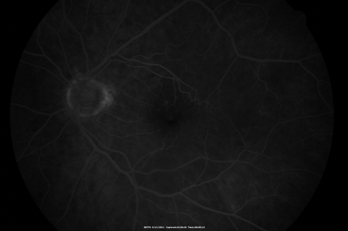 Macular Pucker 20/40 vision and recent cataract surgery
 73-year-old man distortion and vision loss since ECCE 6 months ago OS.  Patient taking anti-inflammatory drops. VISUAL ACUITY:  OD 20/30,  OS 20/40.
