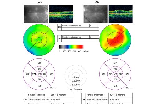 Macular Pucker 20/40 vision and recent cataract surgery
 73-year-old man distortion and vision loss since ECCE 6 months ago OS.  Patient taking anti-inflammatory drops. VISUAL ACUITY:  OD 20/30,  OS 20/40.
