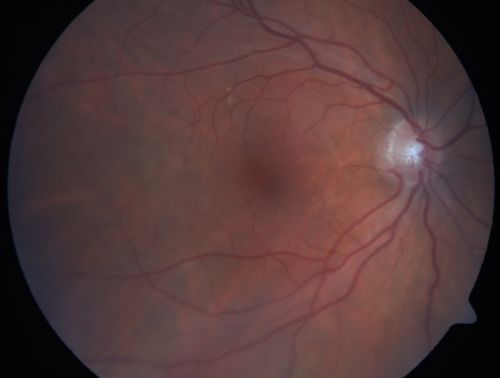Macular Pucker - Diabetic - Severe  non-foveal Edema OS
74-year-old man has a macular pucker in the left eye and diabetic retinopathy.  
VISUAL ACUITY: Vision OD is 20/25, OS is 20/40.
