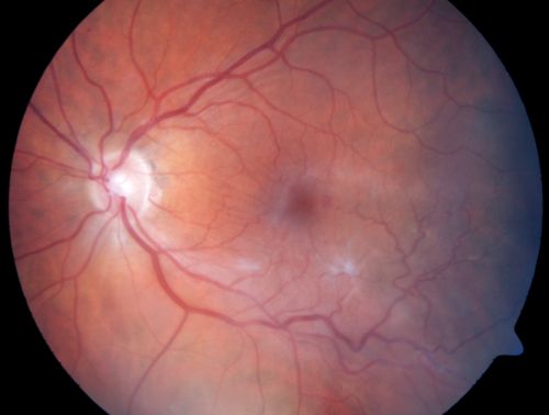 Macular Pucker - Diabetic - Severe  non-foveal Edema OS
74-year-old man has a macular pucker in the left eye and diabetic retinopathy.  
VISUAL ACUITY: Vision OD is 20/25, OS is 20/40.
