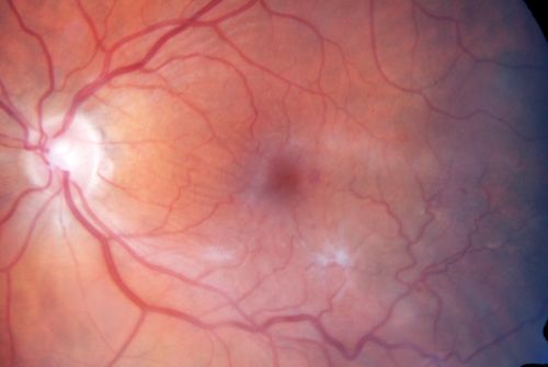 Macular Pucker - Diabetic - Severe  non-foveal Edema OS
