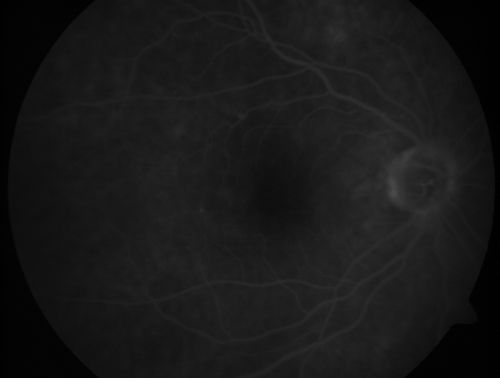 Macular Pucker - Diabetic - Severe  non-foveal Edema OS
74-year-old man has a macular pucker in the left eye and diabetic retinopathy.  
VISUAL ACUITY: Vision OD is 20/25, OS is 20/40.
