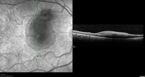 Retinal Arterial Macroaneurysm with pre-retinal hemorrhage
72 year old female who takes Xarelto had sudden vision loss while moving heavy furniture.  VA was 20/200.  The lesion has preretinal blood but later rebled with subretinal blood, was lasered and the final vision was not very good but the patient was lost to follow-up at 3 months
