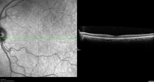 Retinal Arterial Macroaneurysm with pre-retinal hemorrhage
72 year old female who takes Xarelto had sudden vision loss while moving heavy furniture.  VA was 20/200.  The lesion has preretinal blood but later rebled with subretinal blood, was lasered and the final vision was not very good but the patient was lost to follow-up at 3 months
