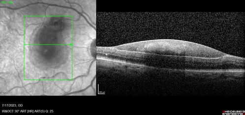 Retinal Arterial Macroaneurysm with pre-retinal hemorrhage
72 year old female who takes Xarelto had sudden vision loss while moving heavy furniture.  VA was 20/200.  The lesion has preretinal blood but later rebled with subretinal blood, was lasered and the final vision was not very good but the patient was lost to follow-up at 3 months
