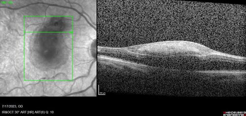 Retinal Arterial Macroaneurysm with pre-retinal hemorrhage
72 year old female who takes Xarelto had sudden vision loss while moving heavy furniture.  VA was 20/200.  The lesion has preretinal blood but later rebled with subretinal blood, was lasered and the final vision was not very good but the patient was lost to follow-up at 3 months
