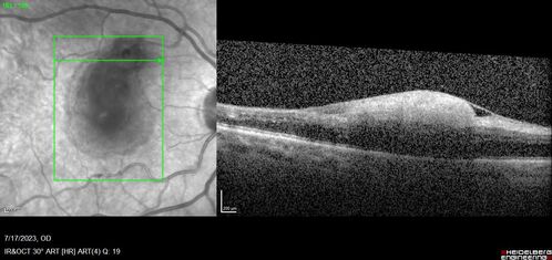 Retinal Arterial Macroaneurysm with pre-retinal hemorrhage
72 year old female who takes Xarelto had sudden vision loss while moving heavy furniture.  VA was 20/200.  The lesion has preretinal blood but later rebled with subretinal blood, was lasered and the final vision was not very good but the patient was lost to follow-up at 3 months
