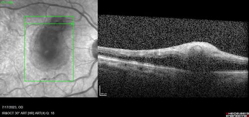 Retinal Arterial Macroaneurysm with pre-retinal hemorrhage
72 year old female who takes Xarelto had sudden vision loss while moving heavy furniture.  VA was 20/200.  The lesion has preretinal blood but later rebled with subretinal blood, was lasered and the final vision was not very good but the patient was lost to follow-up at 3 months
