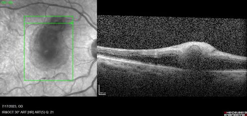 Retinal Arterial Macroaneurysm with pre-retinal hemorrhage
72 year old female who takes Xarelto had sudden vision loss while moving heavy furniture.  VA was 20/200.  The lesion has preretinal blood but later rebled with subretinal blood, was lasered and the final vision was not very good but the patient was lost to follow-up at 3 months
