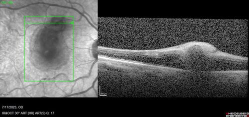 Retinal Arterial Macroaneurysm with pre-retinal hemorrhage
72 year old female who takes Xarelto had sudden vision loss while moving heavy furniture.  VA was 20/200.  The lesion has preretinal blood but later rebled with subretinal blood, was lasered and the final vision was not very good but the patient was lost to follow-up at 3 months
