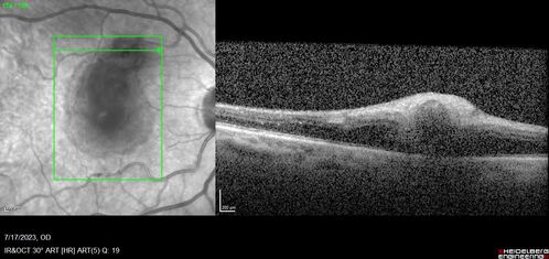 Retinal Arterial Macroaneurysm with pre-retinal hemorrhage
72 year old female who takes Xarelto had sudden vision loss while moving heavy furniture.  VA was 20/200.  The lesion has preretinal blood but later rebled with subretinal blood, was lasered and the final vision was not very good but the patient was lost to follow-up at 3 months
