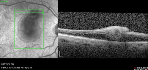 Retinal Arterial Macroaneurysm with pre-retinal hemorrhage
72 year old female who takes Xarelto had sudden vision loss while moving heavy furniture.  VA was 20/200.  The lesion has preretinal blood but later rebled with subretinal blood, was lasered and the final vision was not very good but the patient was lost to follow-up at 3 months
