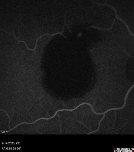 Retinal Arterial Macroaneurysm with pre-retinal hemorrhage
72 year old female who takes Xarelto had sudden vision loss while moving heavy furniture.  VA was 20/200.  The lesion has preretinal blood but later rebled with subretinal blood, was lasered and the final vision was not very good but the patient was lost to follow-up at 3 months
