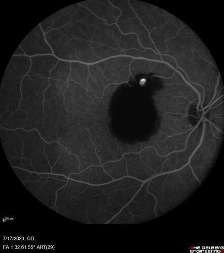 Retinal Arterial Macroaneurysm with pre-retinal hemorrhage
72 year old female who takes Xarelto had sudden vision loss while moving heavy furniture.  VA was 20/200.  The lesion has preretinal blood but later rebled with subretinal blood, was lasered and the final vision was not very good but the patient was lost to follow-up at 3 months
